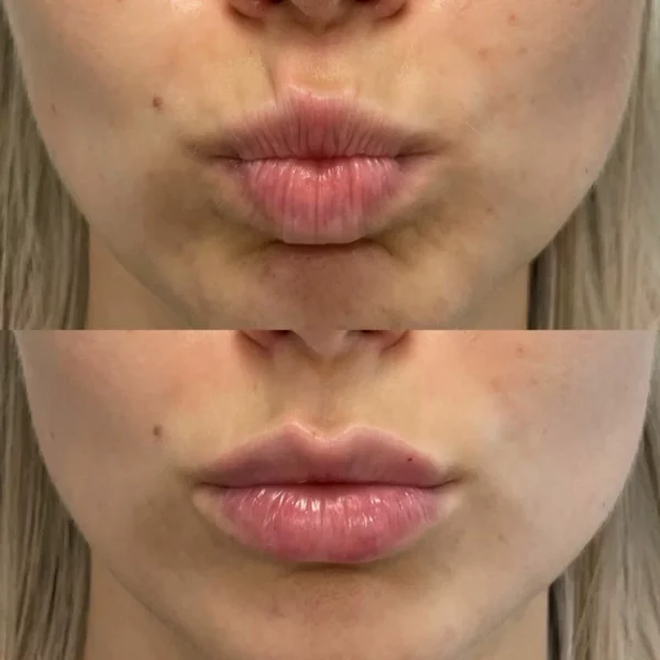 Exploring Botox Lip Enhancement with Dr. Laura Geige